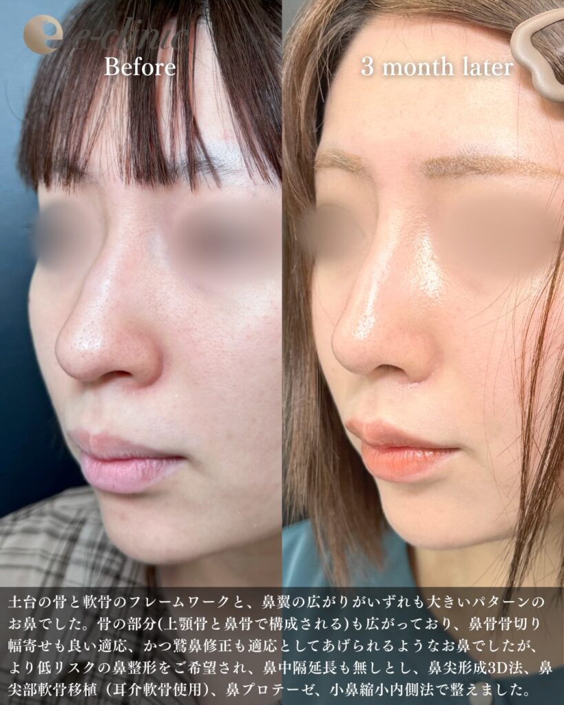 鼻尖形成と軟骨移植とプロテーゼと小鼻縮小の症例写真 (21)