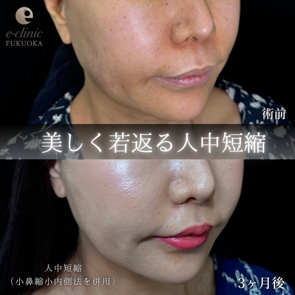 人中短縮と小鼻縮小の症例写真 (3)