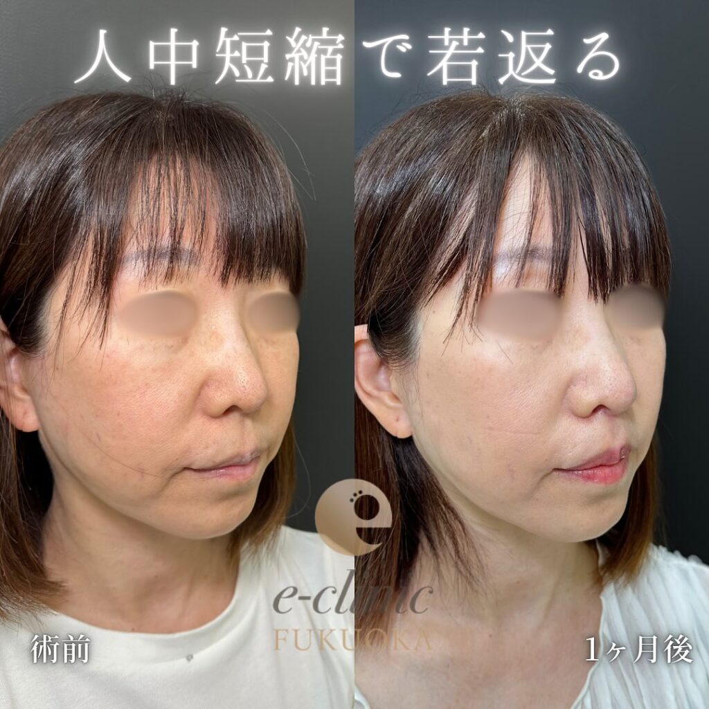 人中短縮の症例写真 (6)