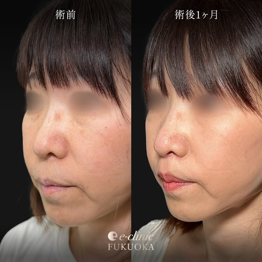 人中短縮の症例写真 (9)