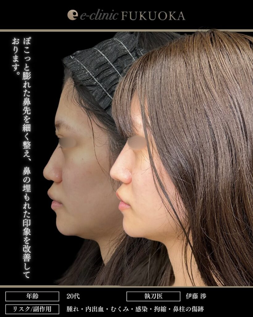 鼻尖形成と耳介軟骨移植と鼻柱下降とプロテーゼの症例写真 (3)