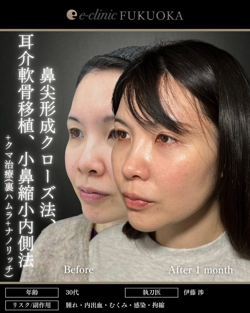 鼻尖形成と軟骨移植と小鼻縮小と裏ハムラ法と脂肪注入の症例写真 (1)