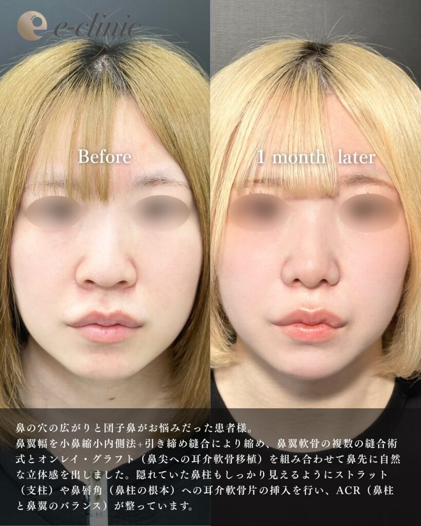 小鼻縮小と小鼻ボトックスと鼻尖形成と鼻中隔延長と軟骨移植の症例写真 (4)