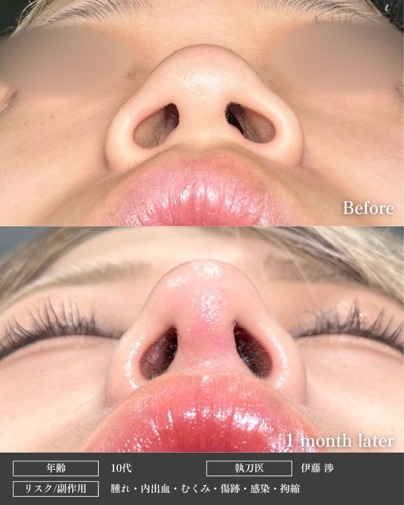 鼻中隔延長と鼻尖形成と軟骨移植と小鼻縮小と鼻柱下降とプロテーゼの症例写真 (5)