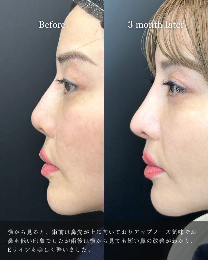 鼻尖形成と軟骨移植とプロテーゼ入れ替えの症例写真 (6)