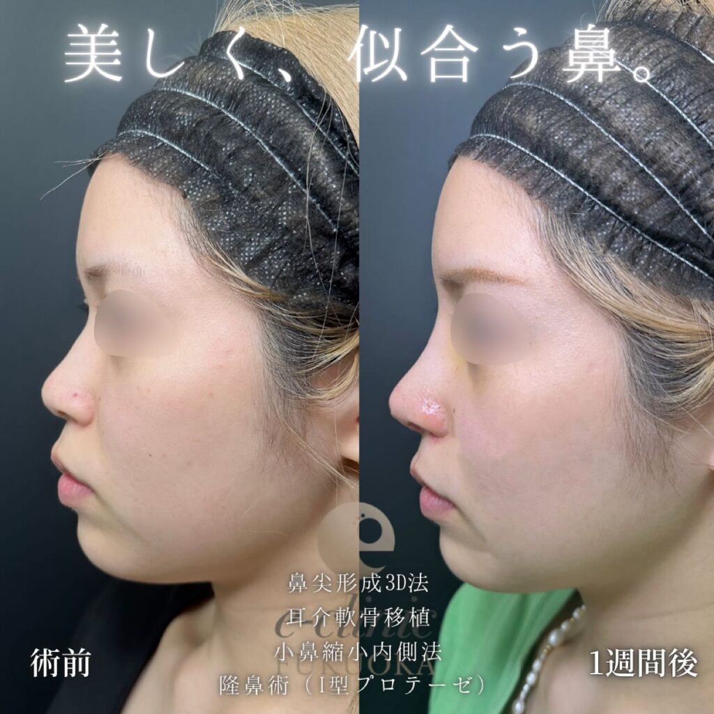 鼻尖形成と軟骨移植と小鼻縮小とプロテーゼの症例写真 (2)