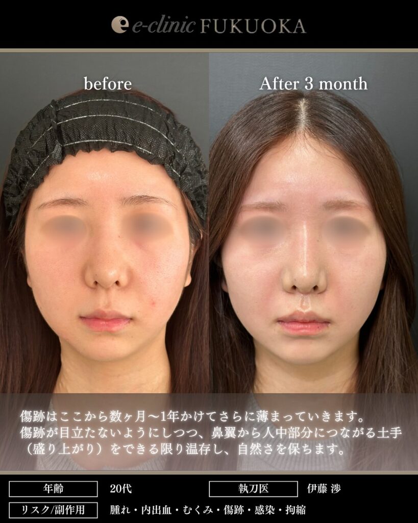 人中短縮の症例写真 (14)