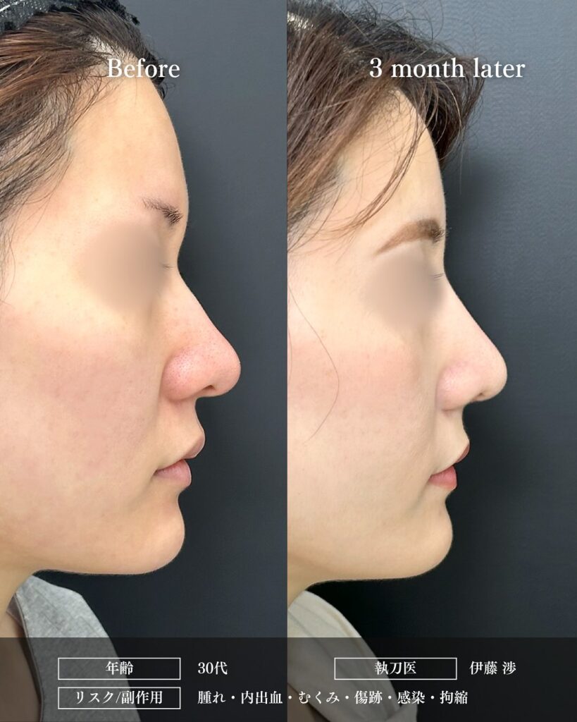 鼻尖形成と軟骨移植とプロテーゼと小鼻縮小と脂肪注入と頬の脂肪吸引とジョールファットと糸リフトの症例写真 (2)