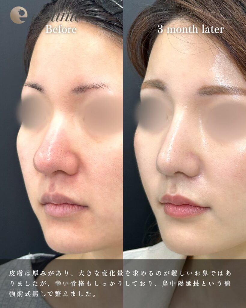 鼻尖形成と軟骨移植とプロテーゼと小鼻縮小と脂肪注入と頬の脂肪吸引とジョールファットと糸リフトの症例写真 (4)