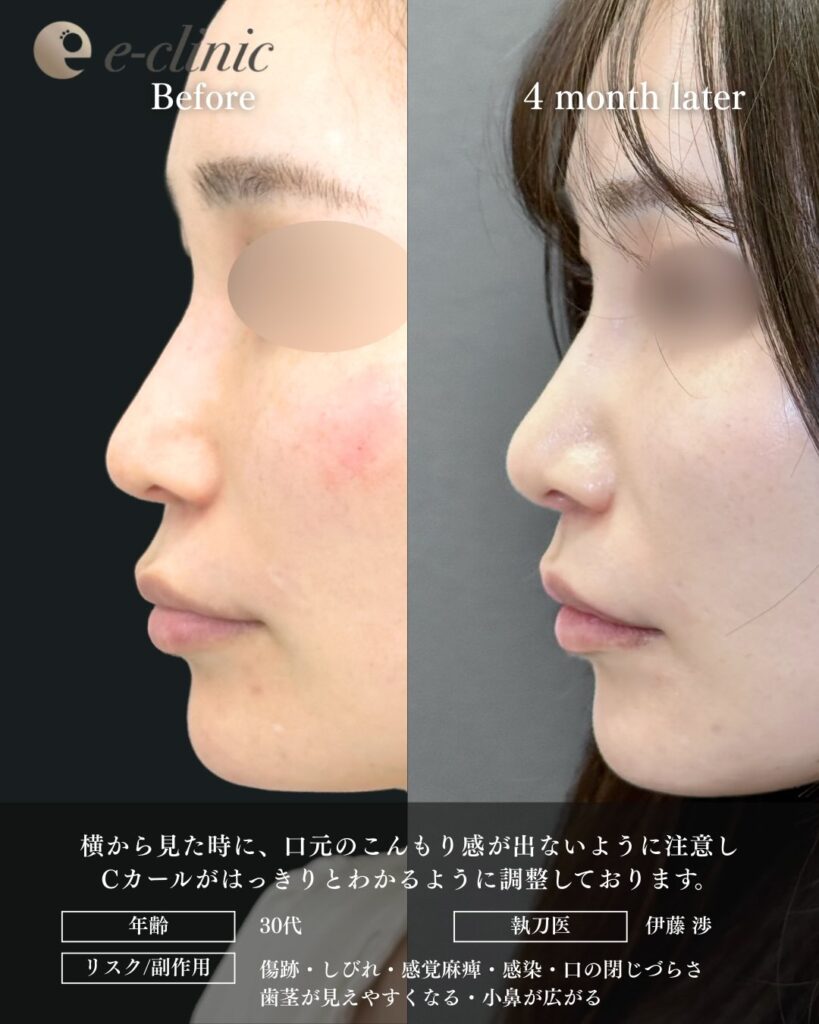 人中短縮の症例写真 (30)