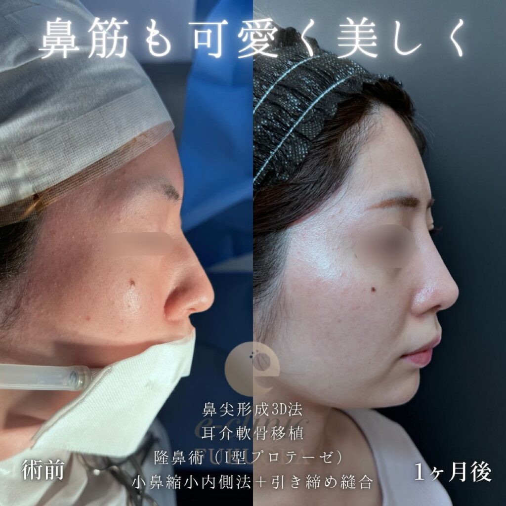鼻尖形成と軟骨移植とプロテーゼと小鼻縮小の症例写真 (4)