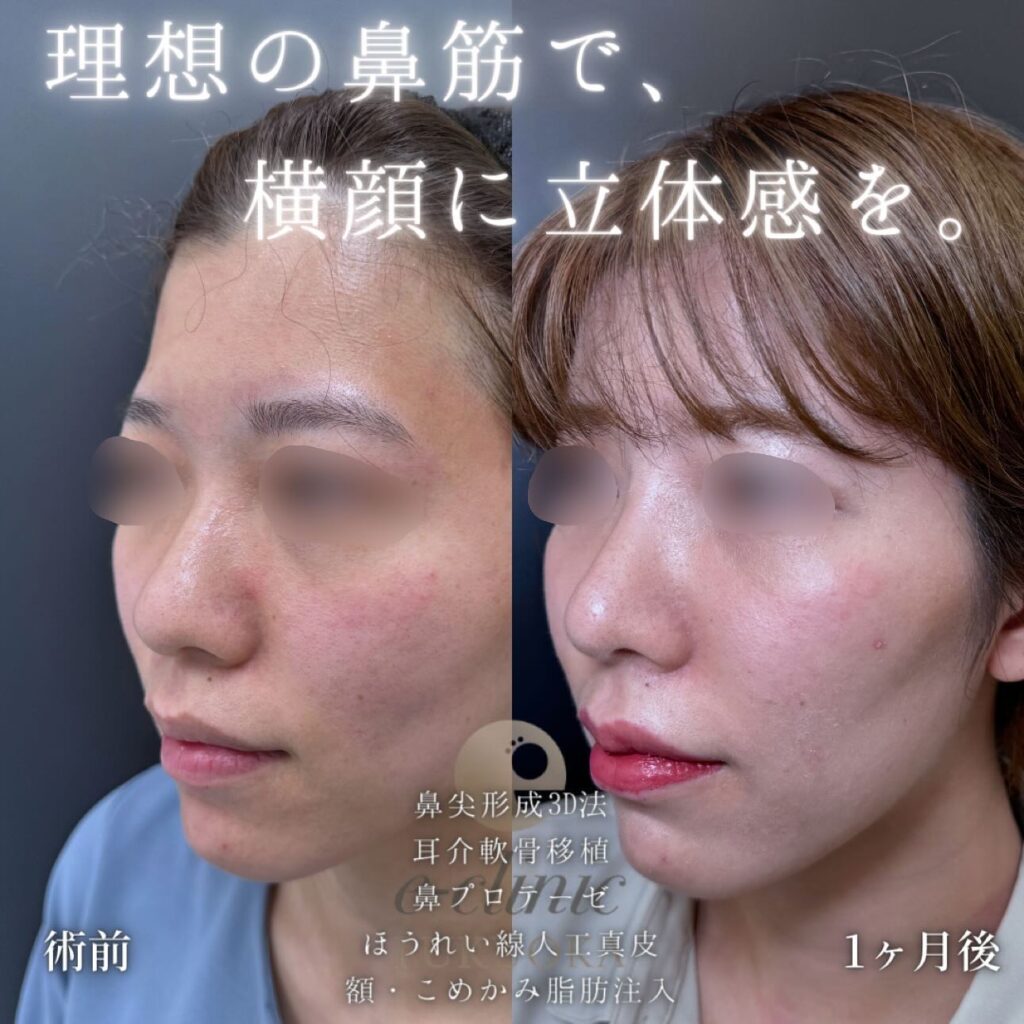 鼻尖形成と軟骨移植とプロテーゼと人工真皮と脂肪注入の症例写真 (1)