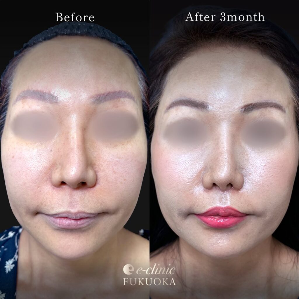 人中短縮と小鼻縮小の症例写真 (5)