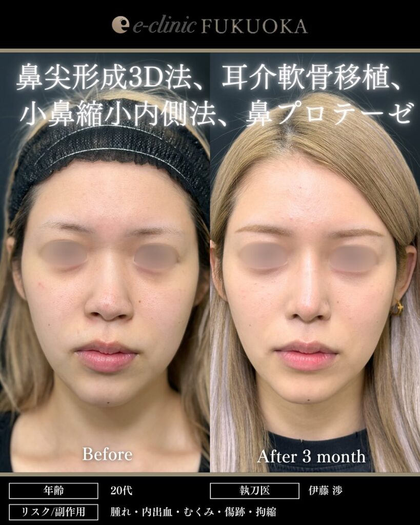 鼻尖形成と軟骨移植と小鼻縮小とプロテーゼの症例写真 (7)