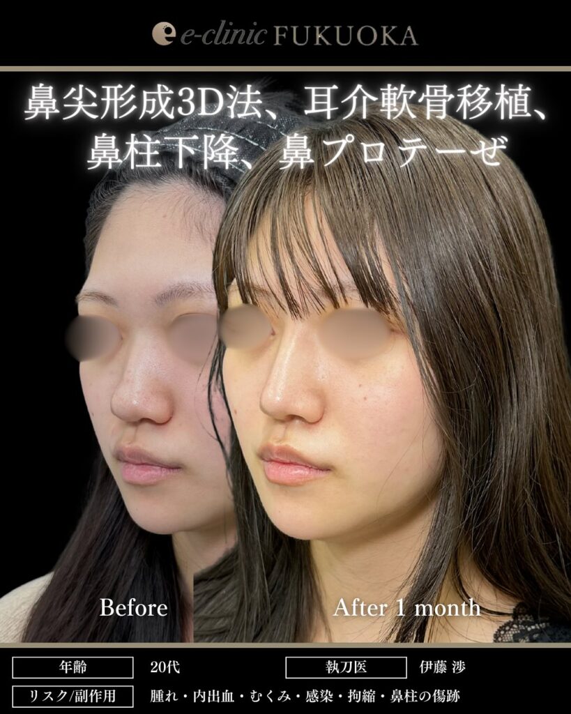 鼻尖形成と耳介軟骨移植と鼻柱下降とプロテーゼの症例写真 (1)