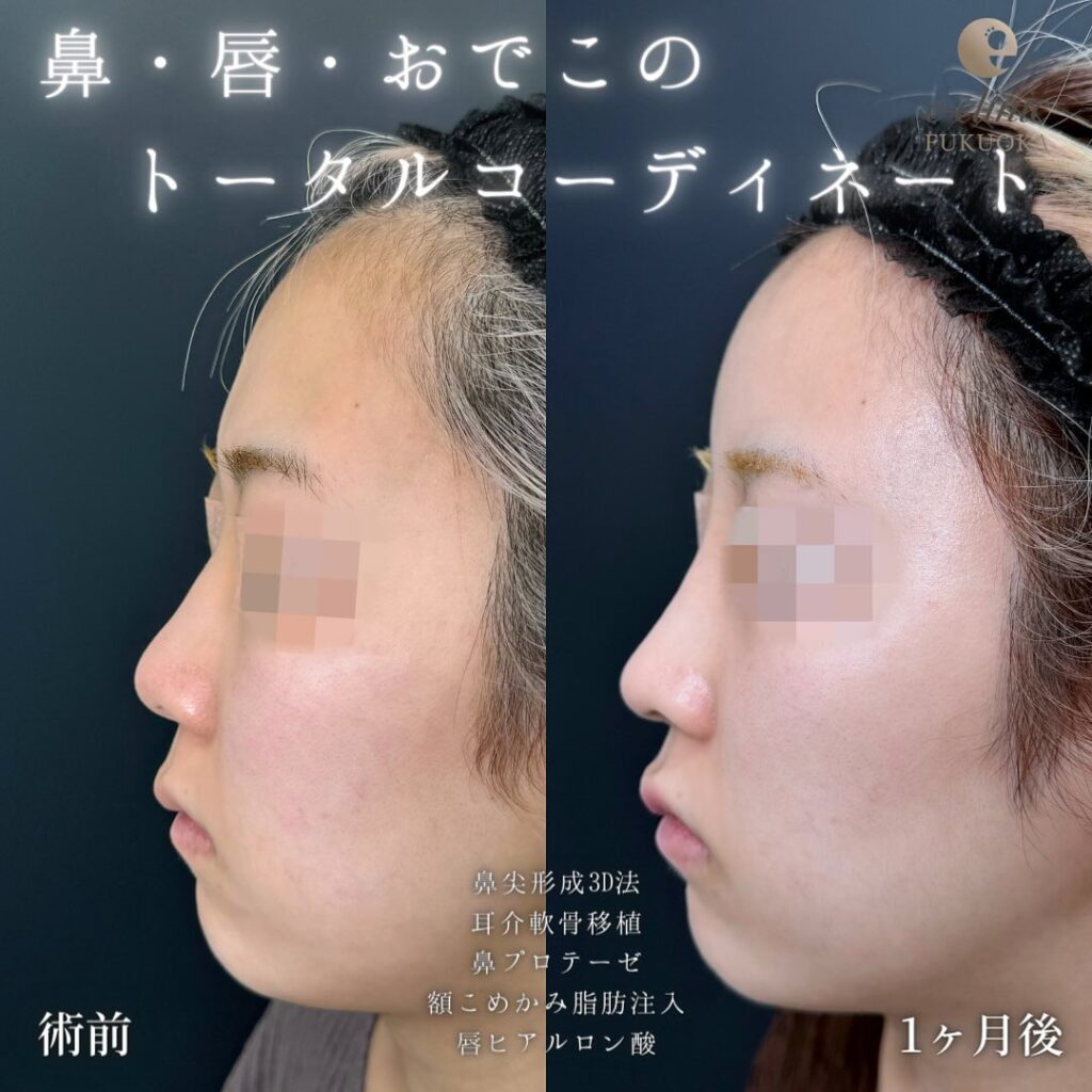 鼻尖形成と軟骨移植とプロテーゼと額とこめかみの脂肪注入と唇のヒアルロン酸の症例写真 (3)