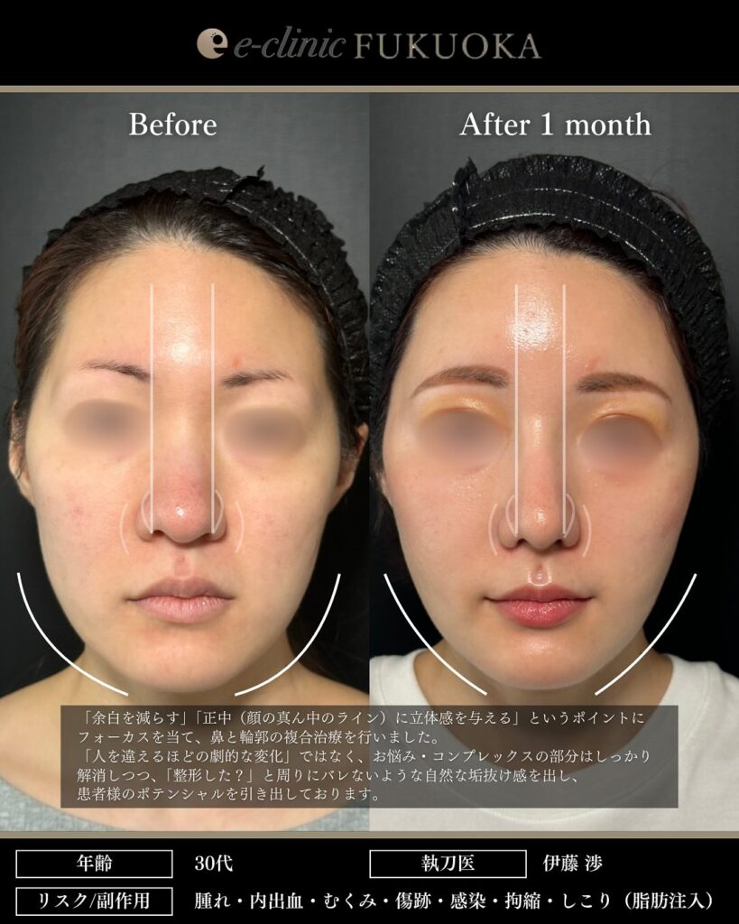 鼻尖形成と軟骨移植と小鼻縮小とプロテーゼと額とこめかみの脂肪注入と頬の脂肪吸引とジョールファットと糸リフトの症例写真 (6)