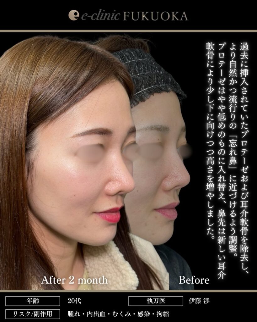 鼻尖形成と軟骨移植と小鼻縮小とプロテーゼと貴族手術の症例写真 (4)