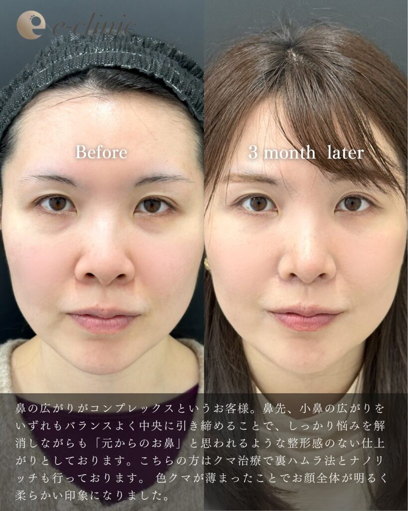 鼻尖形成と軟骨移植と小鼻縮小と裏ハムラ法と脂肪注入の症例写真 (7)