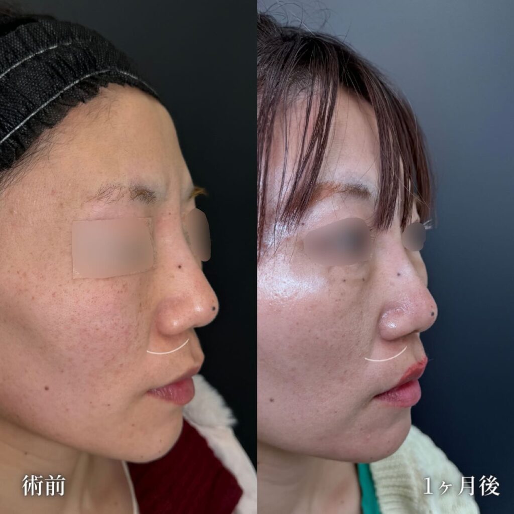 鼻孔縁挙上の症例写真 (2)