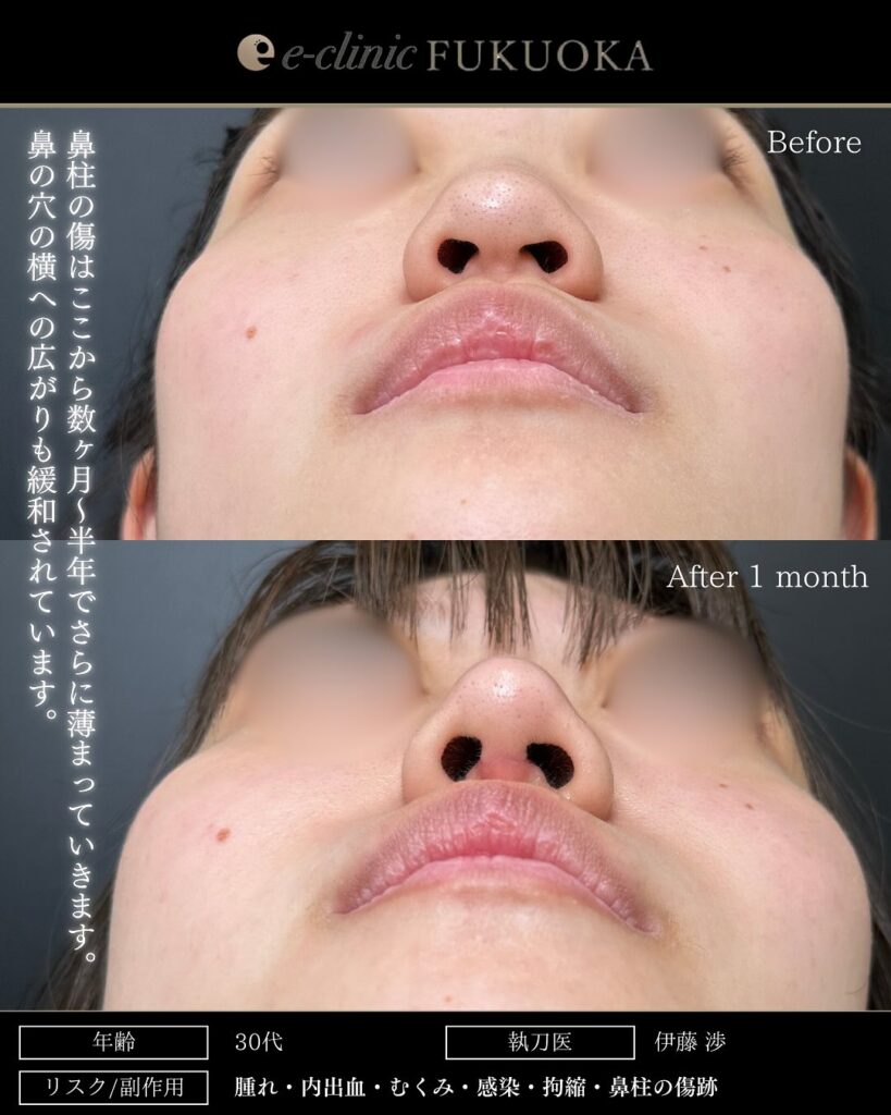 鼻尖形成と耳介軟骨移植と鼻柱下降とプロテーゼの症例写真 (2)