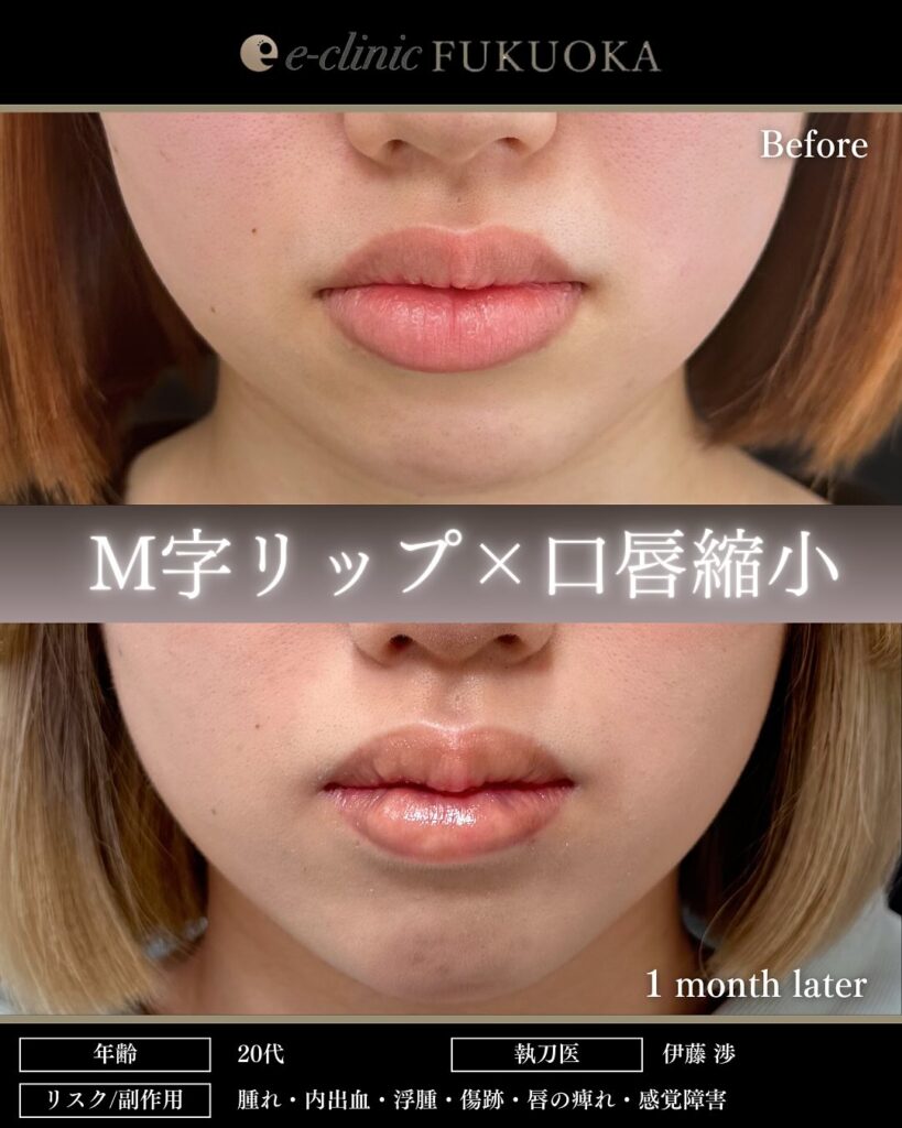 M字リップ+唇縮小の症例写真 (1)