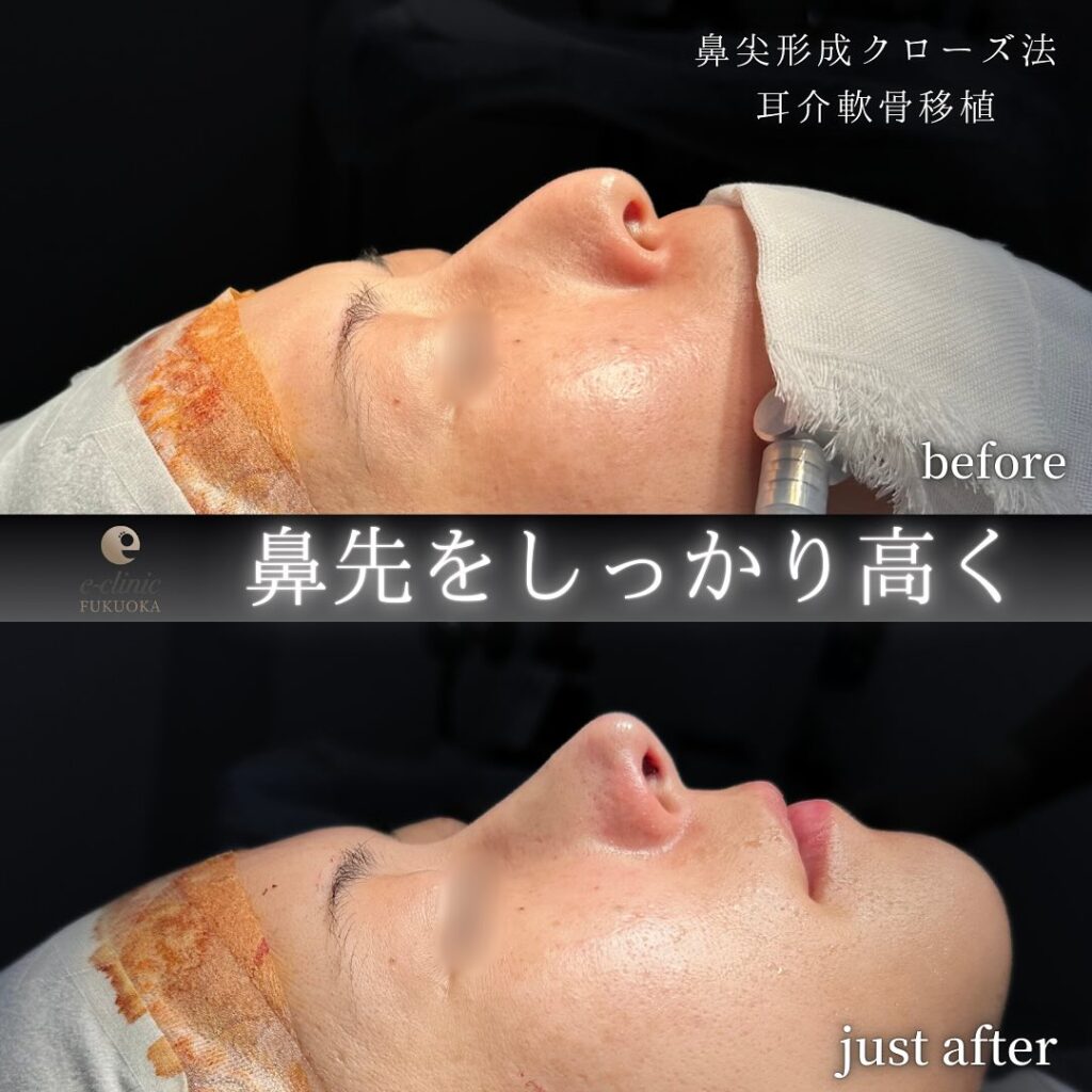 鼻尖形成と軟骨移植の症例写真 (4)