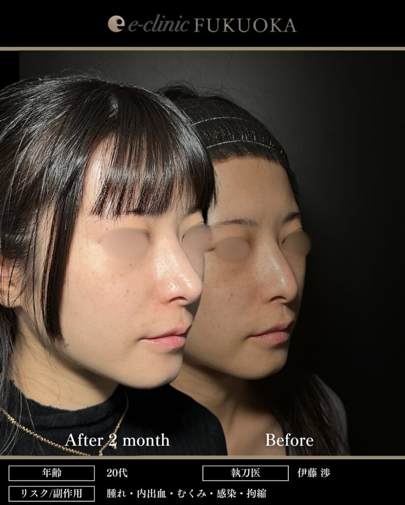 鼻尖形成と軟骨移植の症例写真 (27)