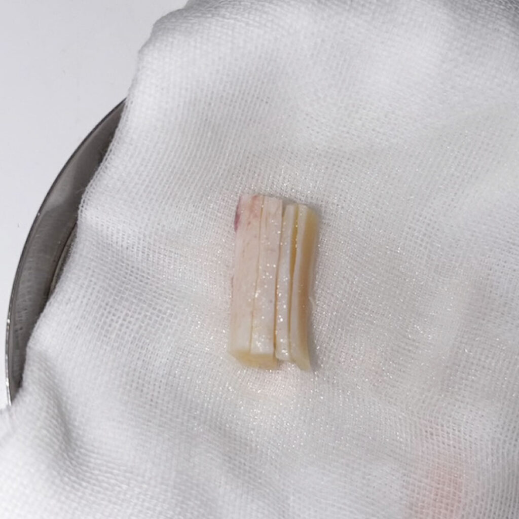 採取した肋軟骨