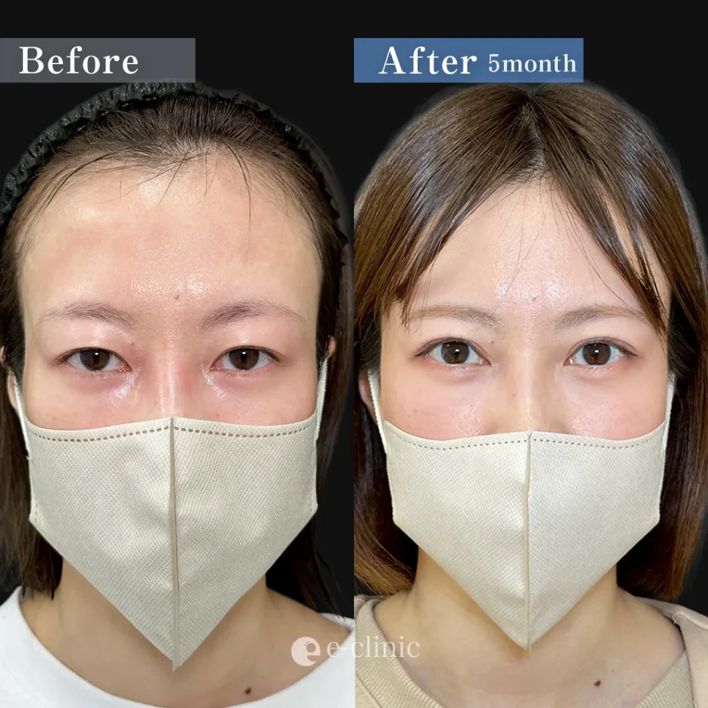 二重切開法_たるみ取り併用全切開二重＋眼瞼下垂（全顔）（伊藤渉）（202）
