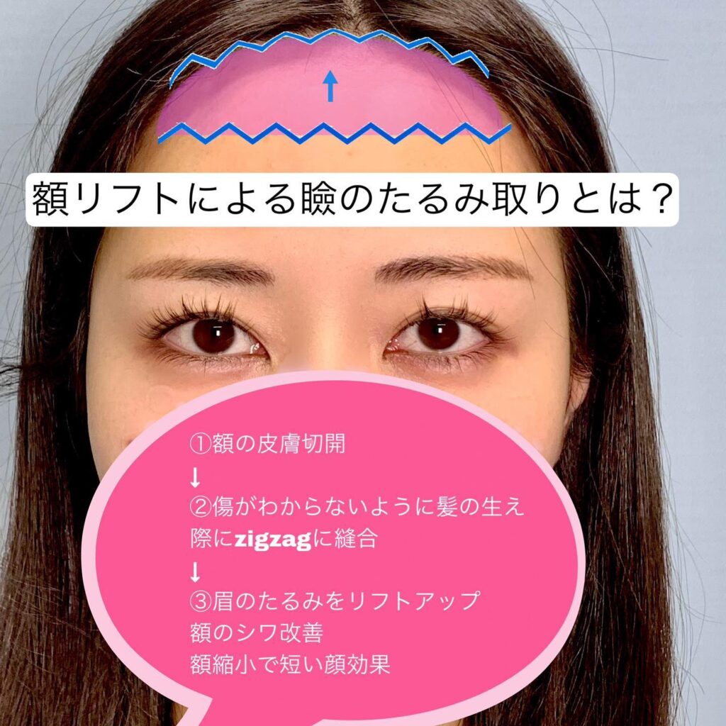 額リフトの症例写真