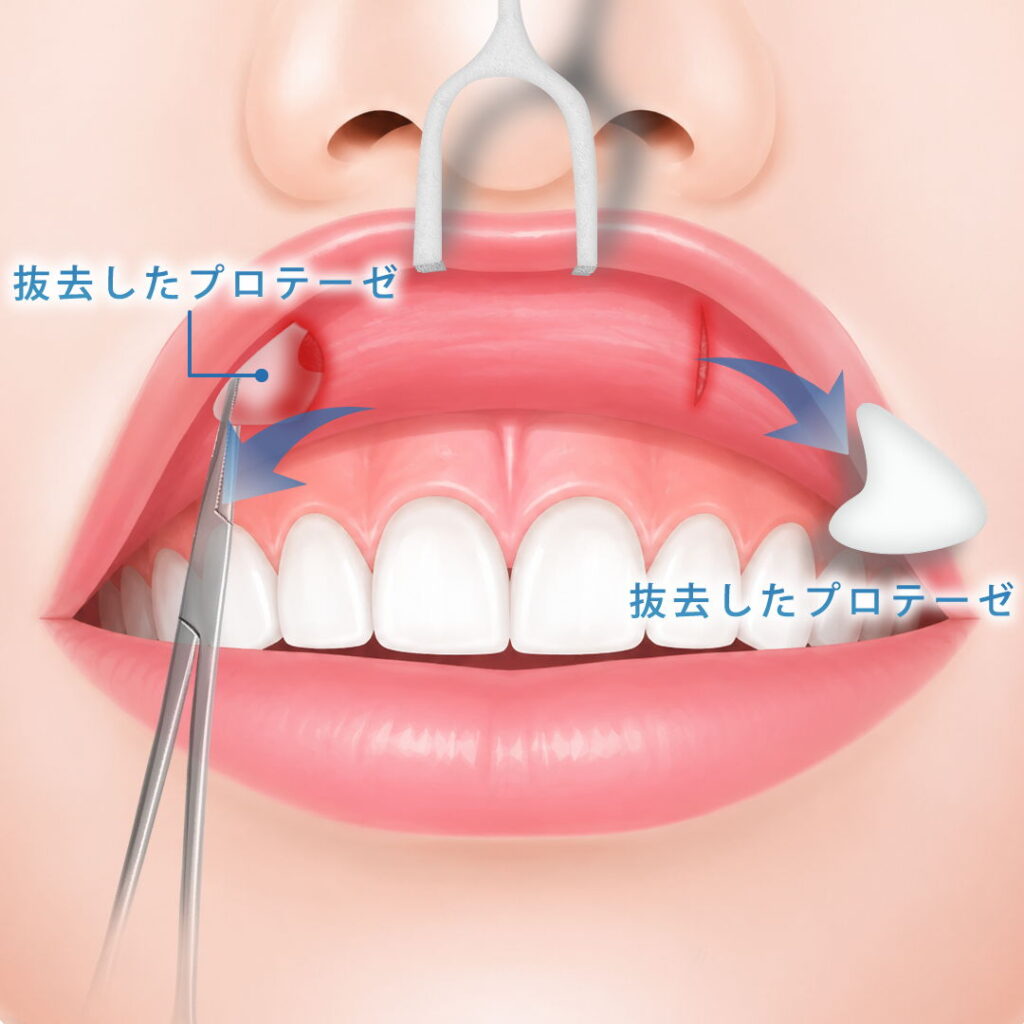 貴族手術でプロテーゼを口腔内から抜去してる図解