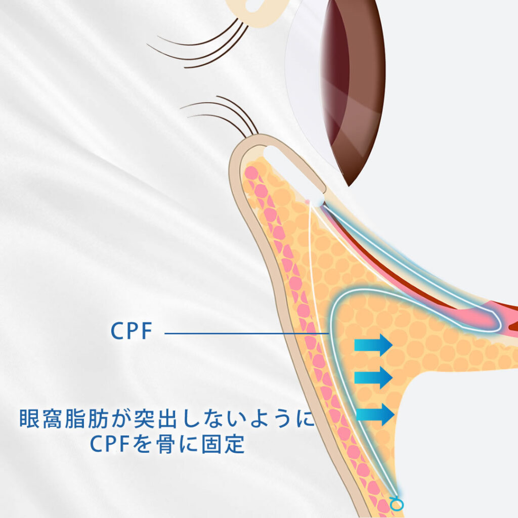 セプタルリセットの図解
