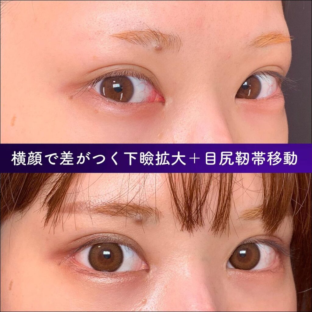 下瞼拡大と目尻切開の症例写真 (2)