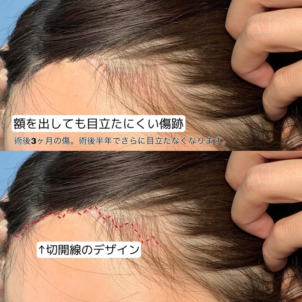 額リフトの症例写真