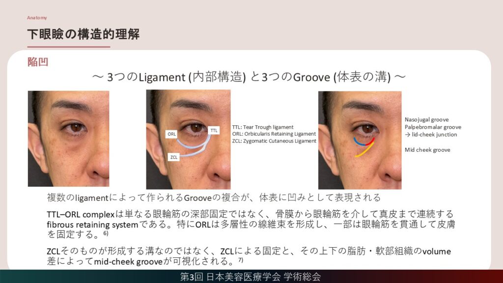 6_下眼瞼の構造的理解(陥凹）